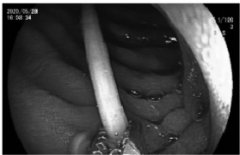 <b>煜星招商主管_喝啤酒误食7厘米长牙签 医护1小时</b>